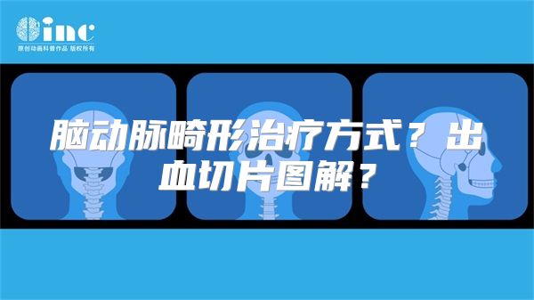 脑动脉畸形治疗方式？出血切片图解？