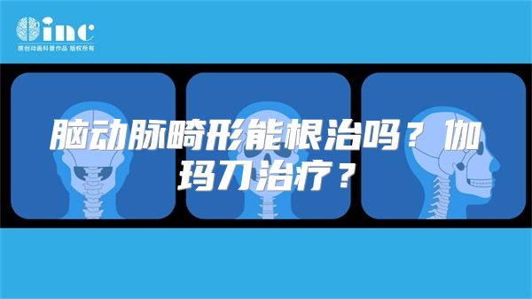 脑动脉畸形能根治吗？伽玛刀治疗？