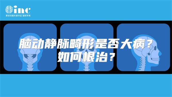 脑动静脉畸形是否大病？如何根治？